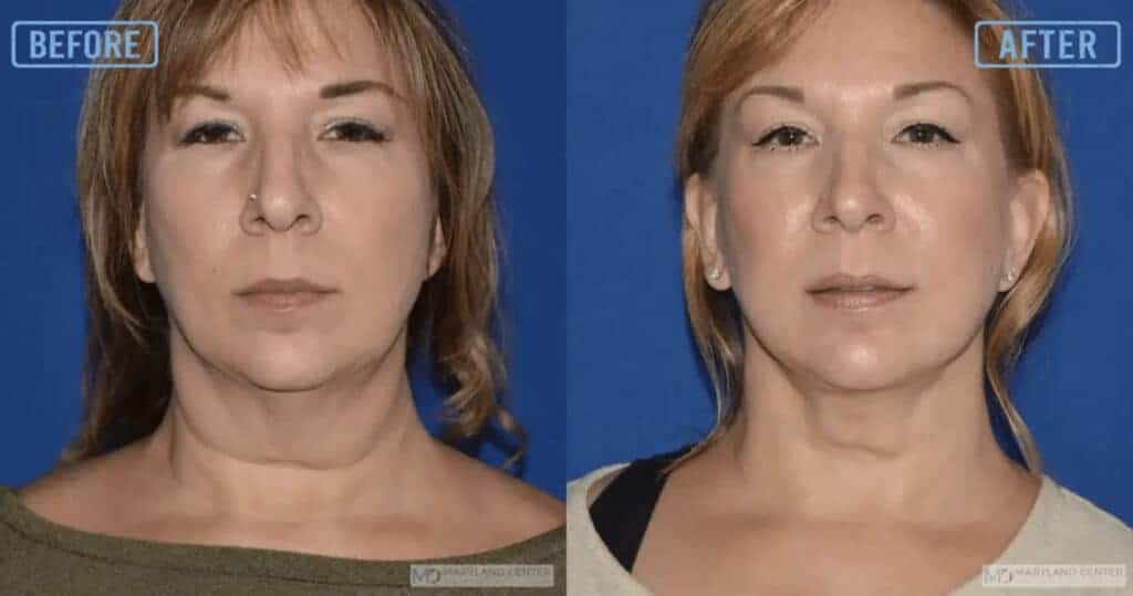 Surgical facelift performed by Dr. Hahn in Balitmore, MD.